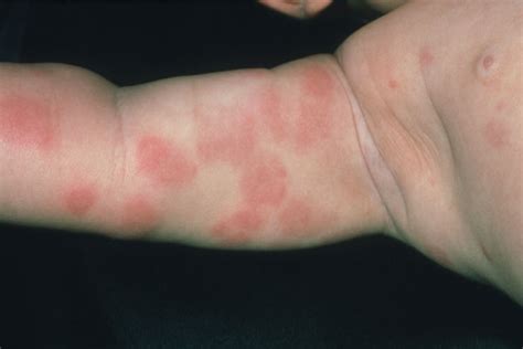 Peanut Allergy Rash