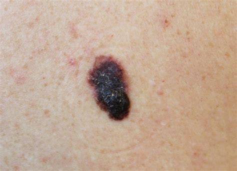 cancerous-mole - Front Range Dermatology