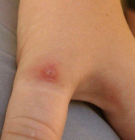 Pictures, Symptoms, and Treatment of Black Widow Spider Bites - HubPages