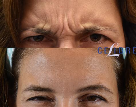 Botox Before and After Pictures: Real Results from Real Patients