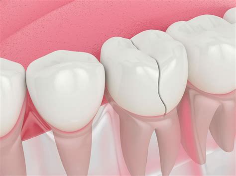 Procedures to Repair Your Cracked or Broken Tooth | Cracked Tooth