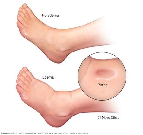 Edema - Swelling of Feet & Legs – Dr. Segal's