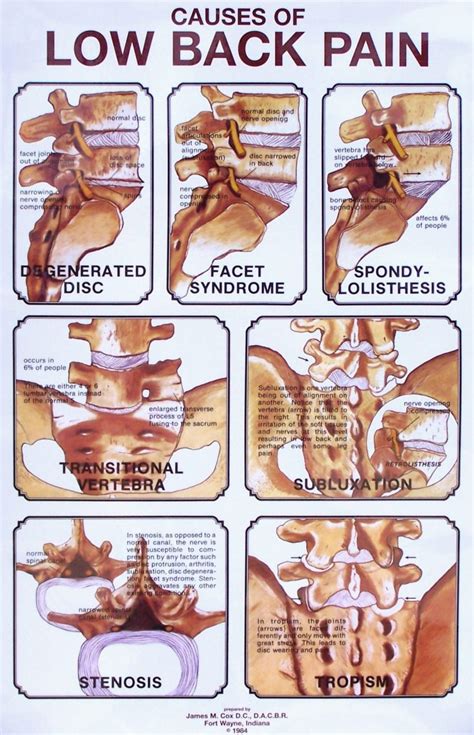 Causes of Low Back Pain