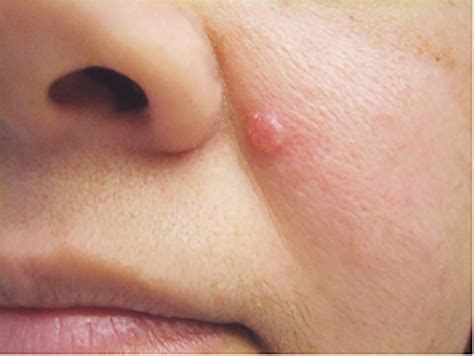 The Most Common Skin Cancer: Basal Cell Carcinoma – Skin Cancer Diagnosis