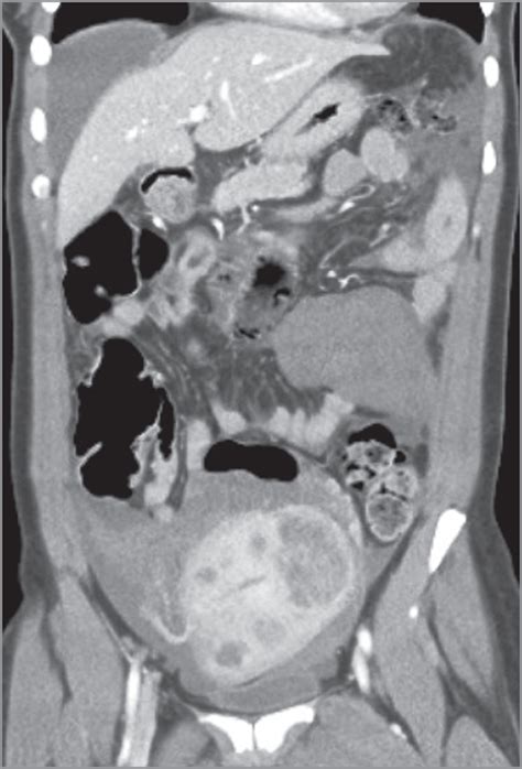 Traumatic Hemoperitoneum | Critical Care Medicine | JAMA Surgery | The JAMA Network