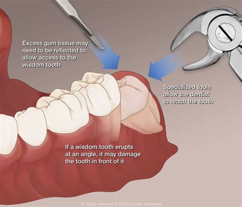 Wisdom Teeth Removal Warsaw, IN - Dental Solutions