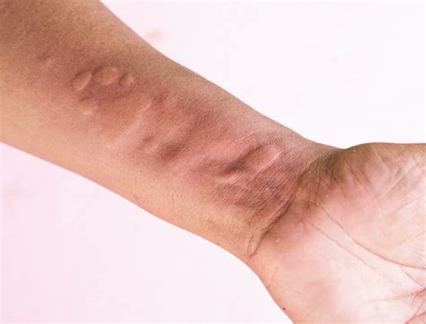 What Drugs Can Cause Hives at Bridgett Bradbury blog