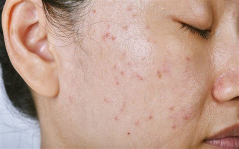 Understanding Acne Papules: Causes, Treatment, and Prevention Strategies: The Derm Spot