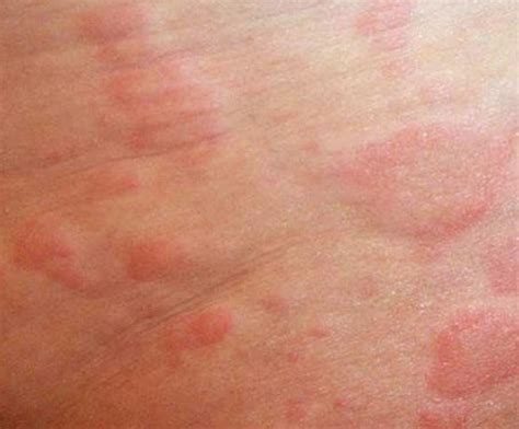 Skin Rash Adults Types