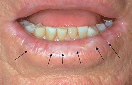 Skin Cancer Lower Lip Photos - Infoupdate.org