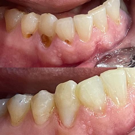 3 Cavity Fillings (before and after) | Give Dental Care