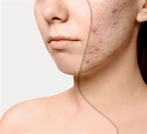 Acne Scar: Causes, Types, and Non-Invasive Treatments - Digital For Health : Tips to improve ...