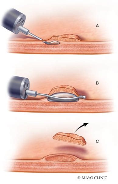 Colorectal Cancer Polyps