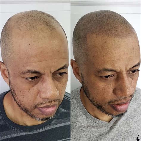 Hairline Tattoo - Cosmetic Tattoo for a Receding Hairline