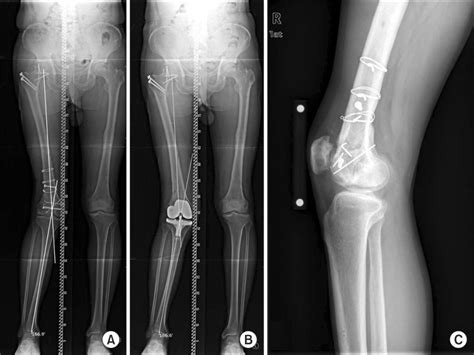 Radiographic images of case No. 9: 13° of valgus hip-knee-ankle axis in... | Download Scientific ...