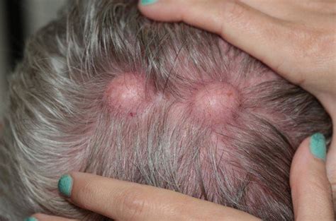 Pilar Cyst - (On scalp), Pictures, Home Treatment and Removal