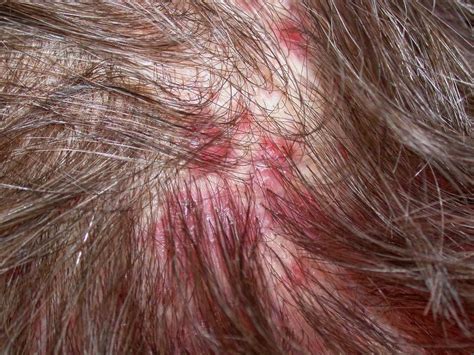 pilar cysts on scalp - pictures, photos