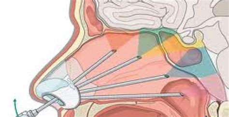 Brain Tumor: Causes, Classification & Surgery Procedure - Brain-Surgery.com