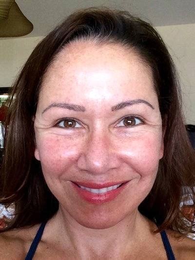 SMAS Facelift Recovery Swelling Photos (6) » Facelift: Info, Prices, Photos, Reviews, Q&A