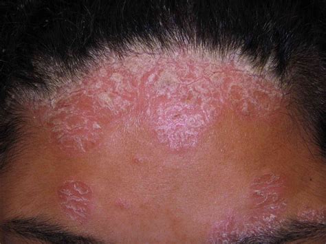 Psoriasis On The Face: Symptoms, Causes, Treatment, And, 56% OFF