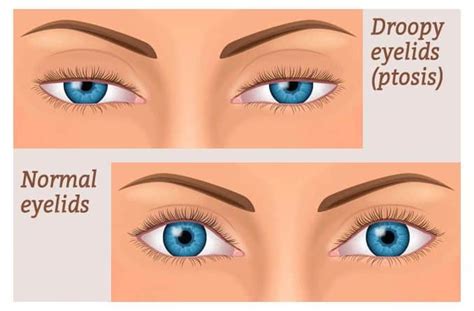 Tackling Heavy Eyelids: Causes, Non-Surgical & Surgical Treatments ...