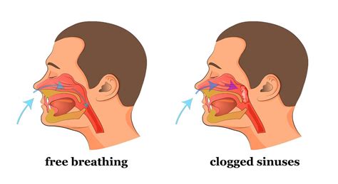 Do You Have a Stuffed Nose Or Clogged Sinuses? This Simple Trick Will ...