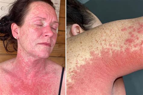 Mum left in agony with a burning rash due to 'severe reaction to Covid vaccine two weeks after ...