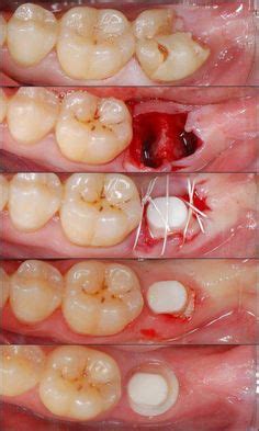 Wisdom Teeth Removal Cost San Antonio - Teeth Poster