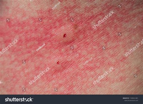 34 Spider Insect Bite Rash Images, Stock Photos & Vectors | Shutterstock