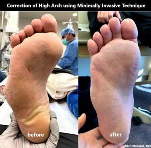 High arch is causing my foot problems. What is the solution? - CNOS