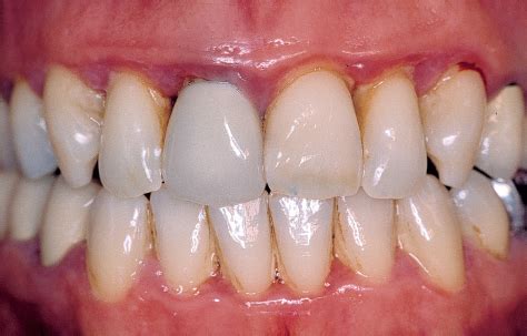 Periodontitis Treatment