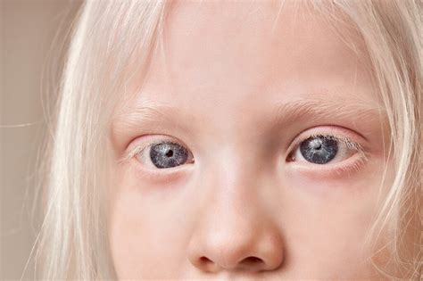 Albino Eye Color: Understanding Its Unique Appearance