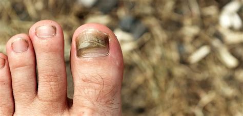 Where Toenail Fungus Hides - Palmetto State Podiatry