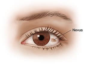 Understanding Nevus (Eye Freckle) | Saint Luke's Health System