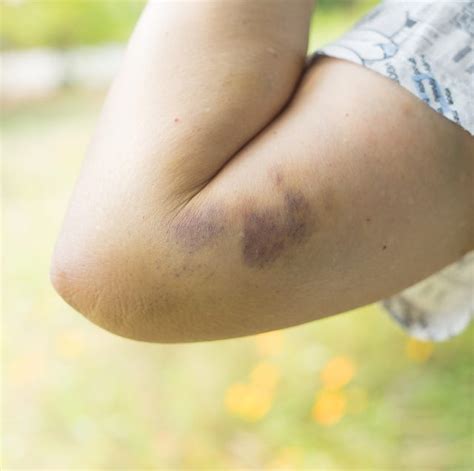 Why Do I Bruise So Easily? - 8 Odd Causes Of Bruising Easily