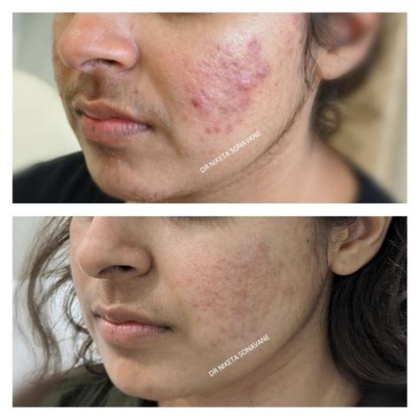 Acne Scar Treatment in Mumbai – Cost, Before After Results, Laser