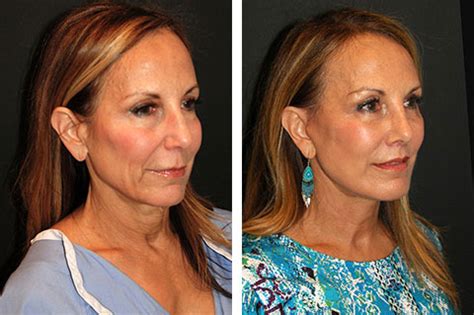 SMAS Facelift | Best SMAS Facelift Surgeon New York