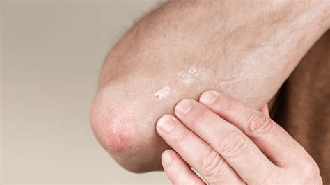 Skin Flakes (Scaly Skin): Causes, Treatment & Home Remedies | Clinikally