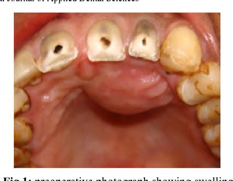 Figure 1 from Radicular cyst: A case report | Semantic Scholar