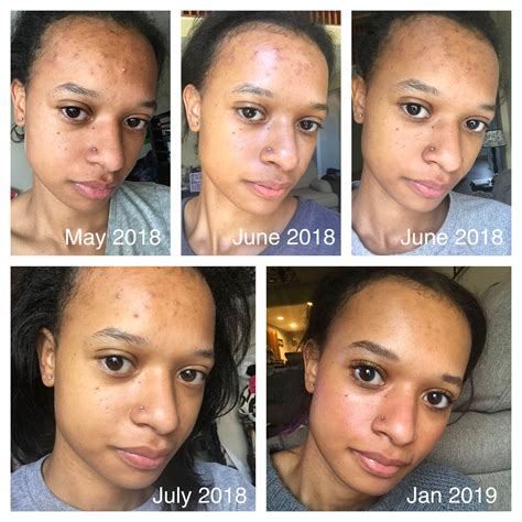 [B&A] BR Lotion P50 saved my skin from Differin purge in 3 months + 7 month progress ...