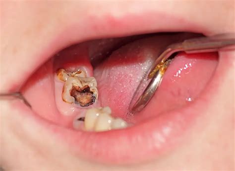 Can a Badly Decayed Tooth be Saved? Tips from a Friendly Dentist