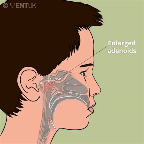 Adenoid Surgery | ENT UK