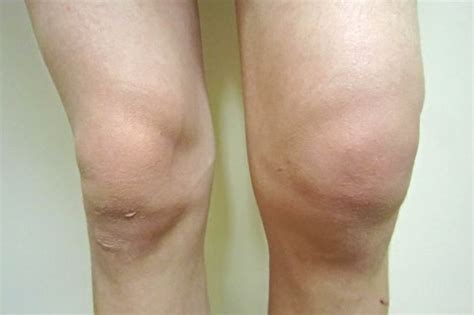 Knee Bursitis – Spine Sports Chiro