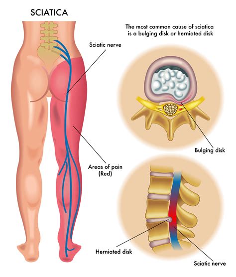 Sciatica Pain - Hip Pain Causes, Symptoms & Treatment