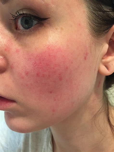 [skin concerns] is this Rosacea? My face looks like this when I wake up. : r/SkincareAddiction