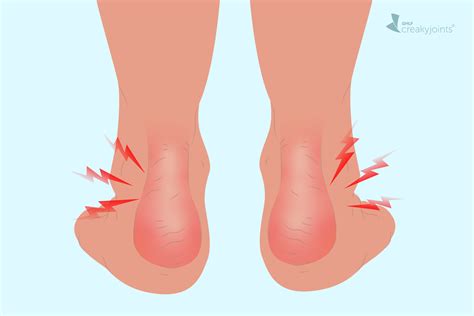 Psoriatic Arthritis in the Ankle: Symptoms, Causes, Treatments