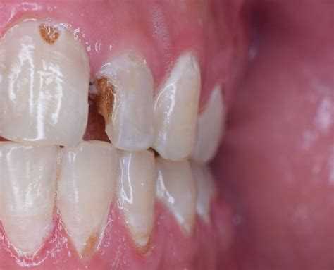 Tooth Decay – The stages - Shandon Dental - Cork City Dentist