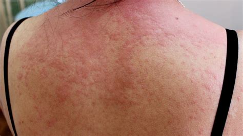 Acute Hives: Causes, Symptoms & Treatment - Hives Treatments