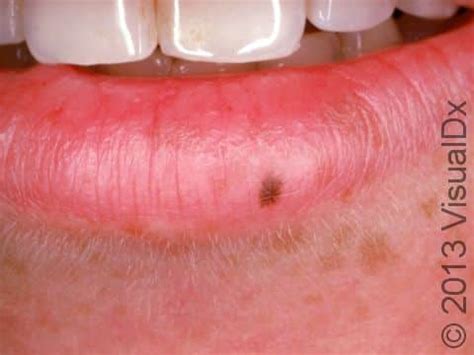 Melanoma On Lip Pictures In English - Infoupdate.org