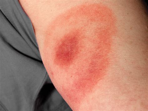 5 Common Tick Bite Symptoms, and 8 Ways to Prevent Getting Bit